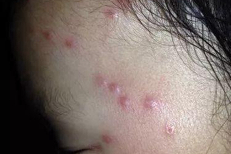 昆虫性皮炎面部丘疹图 昆虫性皮炎面部丘疹图