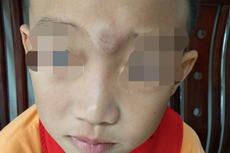 撞伤前额症状图