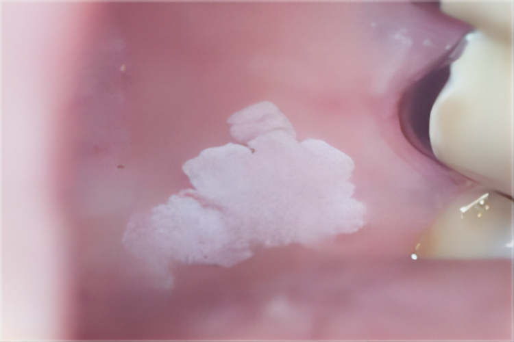 口腔黏膜白斑增生图