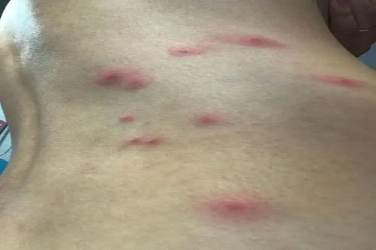 黄蚂蚁咬人丘疹图 黄蚂蚁咬人丘疹图