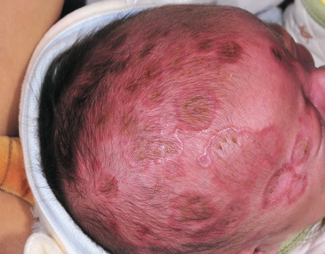 早期先天梅毒皮损图