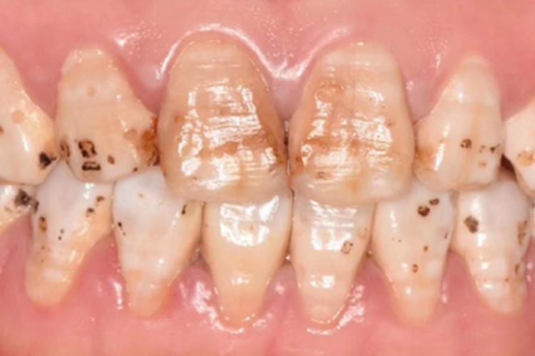 氟斑牙牙齿发黄粗糙有坑图 氟斑牙牙齿发黄粗糙有坑图