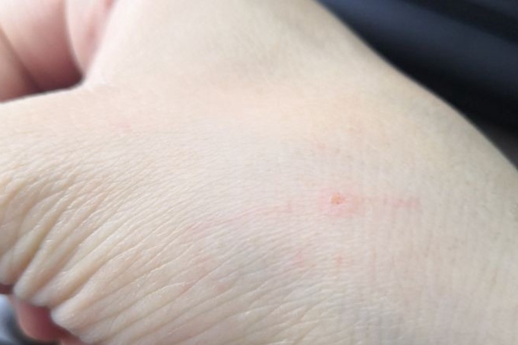 被小狗咬了伤口轻微图