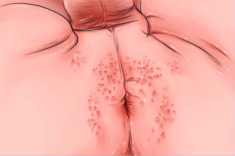 尿布皮炎肛周渗液手绘图