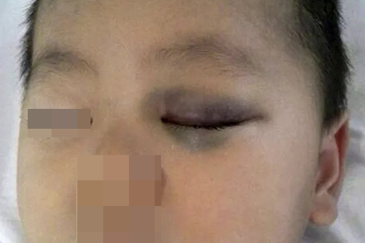 外伤眼窝发紫图