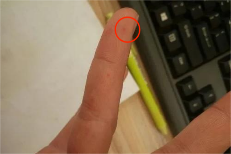 手指头上过敏性紫癜红点图