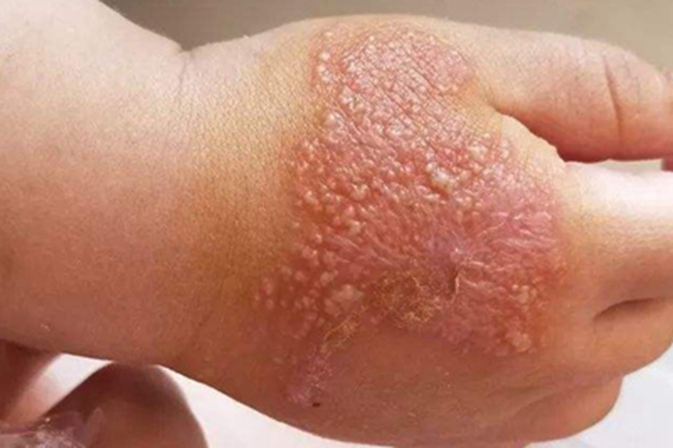 小儿海鲜过敏糜烂结痂图