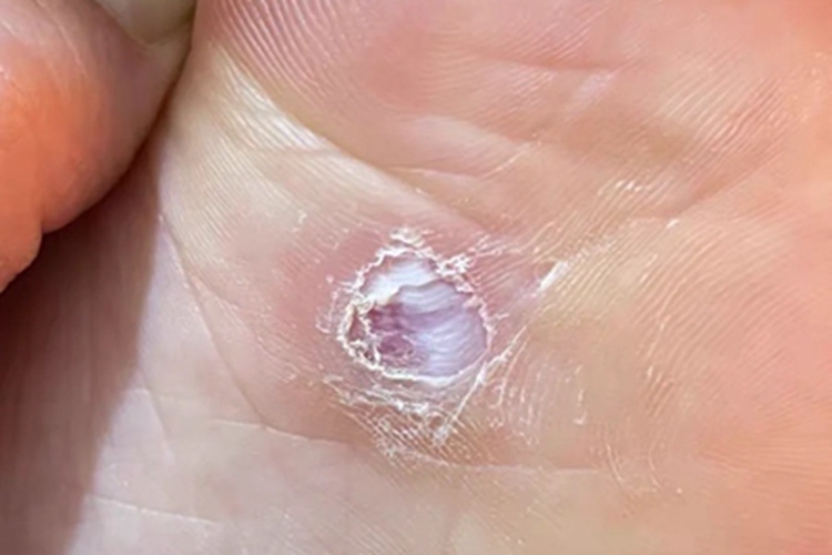 胼胝脚底有硬块伴白色脱皮图