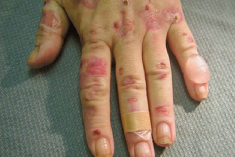 原卟啉病手部大水疱图