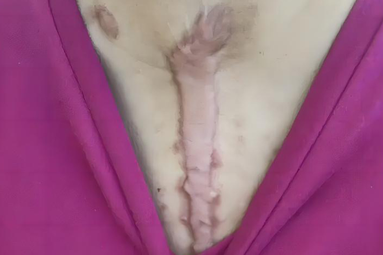 胸部瘢痕疙瘩图
