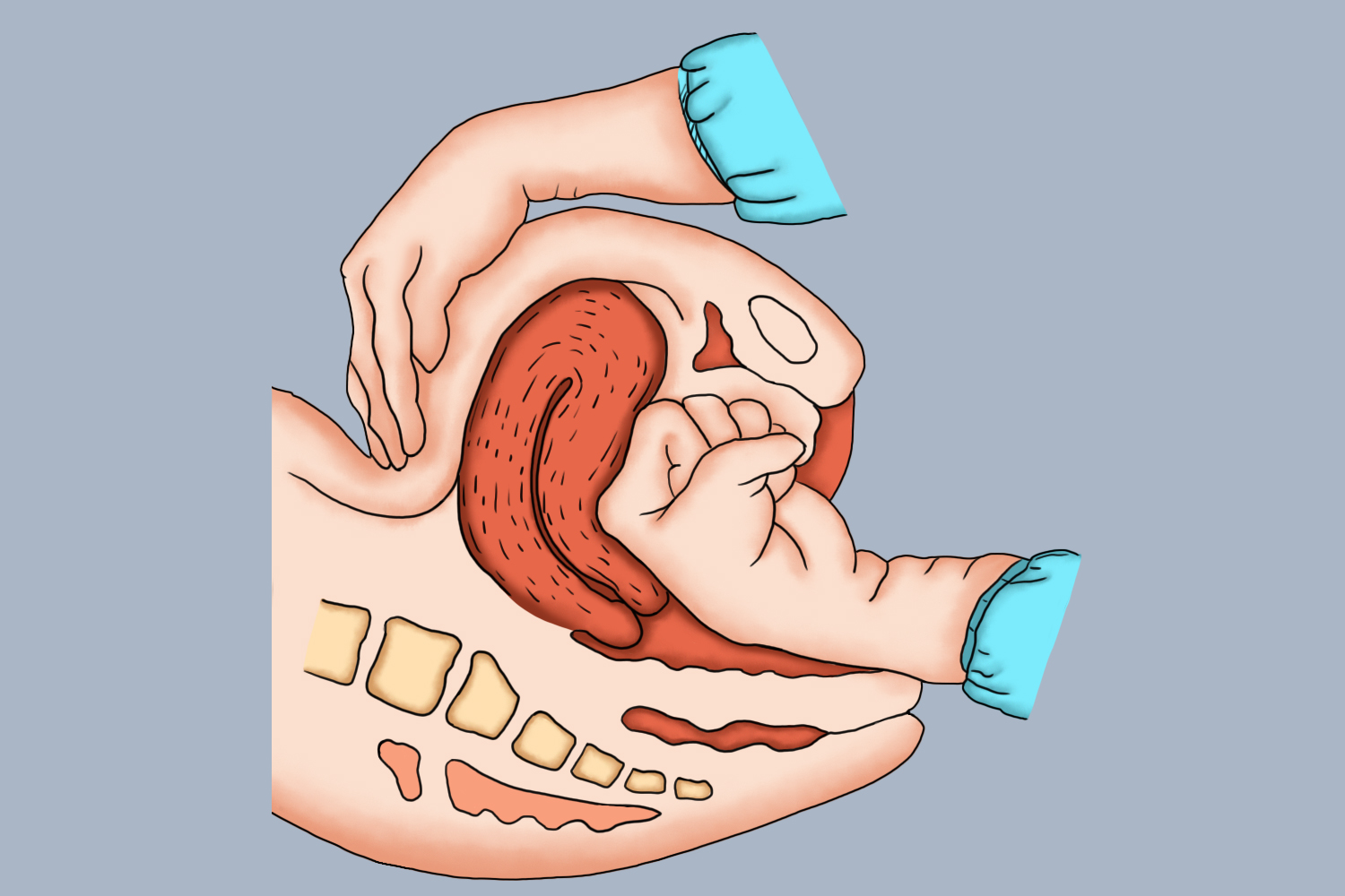 腹壁-阴道按摩子宫法图