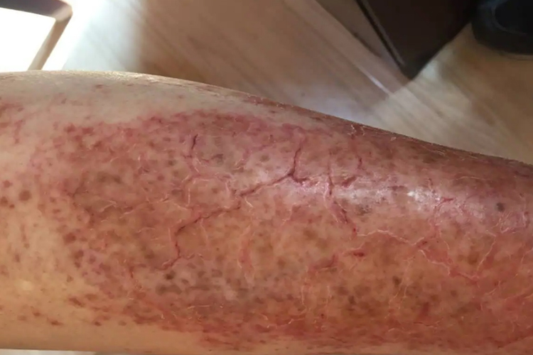 腿部渗出结痂图 腿部渗出结痂图