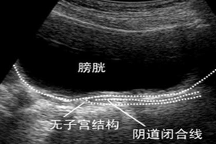 石女盆腔B超检查图
