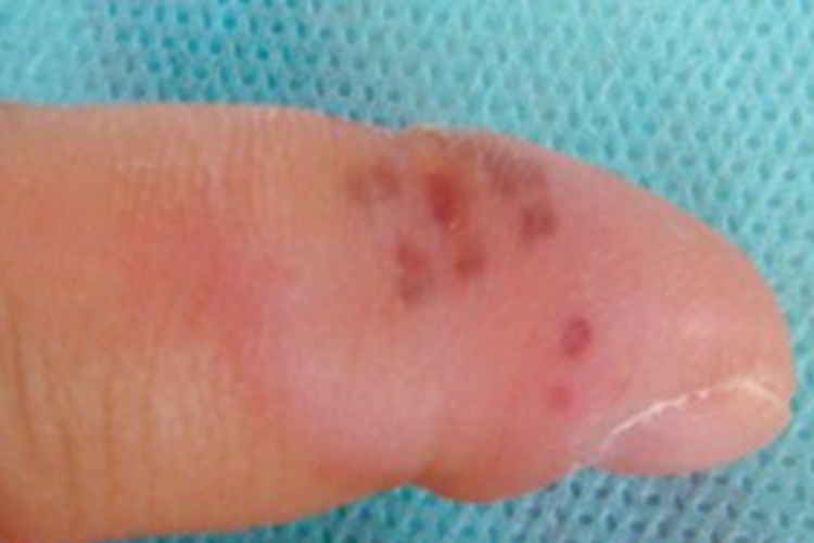 局限型类丹毒手部症状图