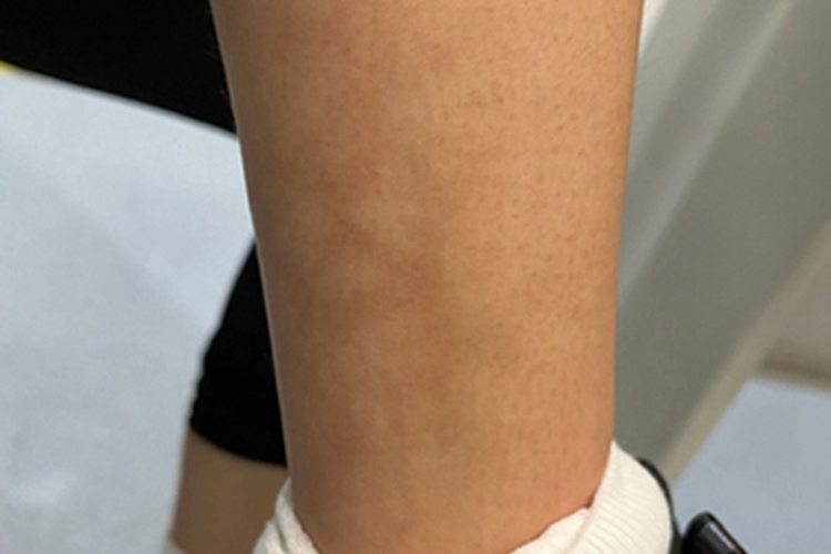 火激红斑小腿皮肤颜色加深图 火激红斑小腿皮肤颜色加深图