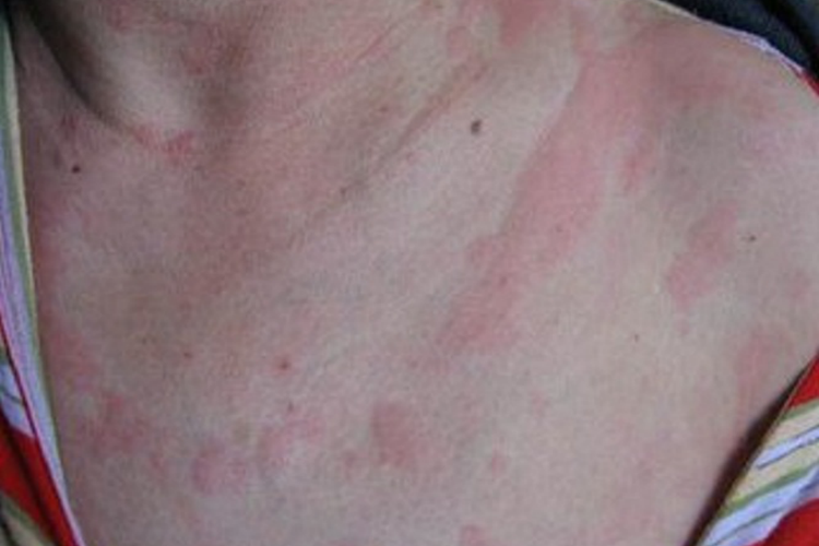 荨麻疹前胸红印图