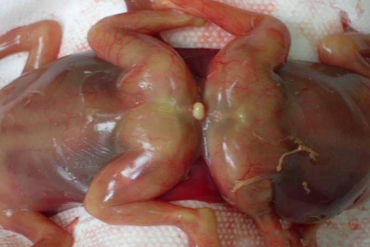 孕11周引产联体双胎背面图