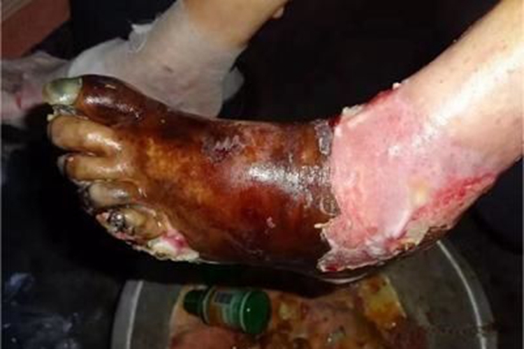 烫伤脚部黑痂图 烫伤脚部黑痂图
