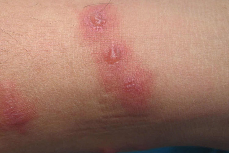 蜱叮咬瘀点周围出现丘疹或水疱图