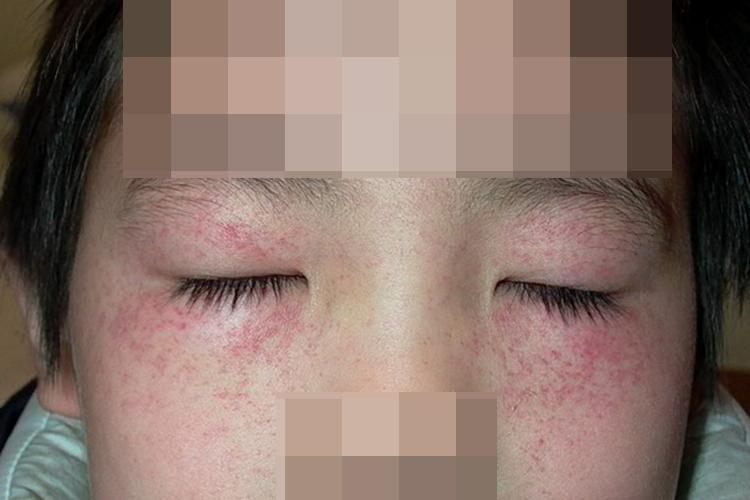 小孩面部过敏性紫癜图 小孩面部过敏性紫癜图