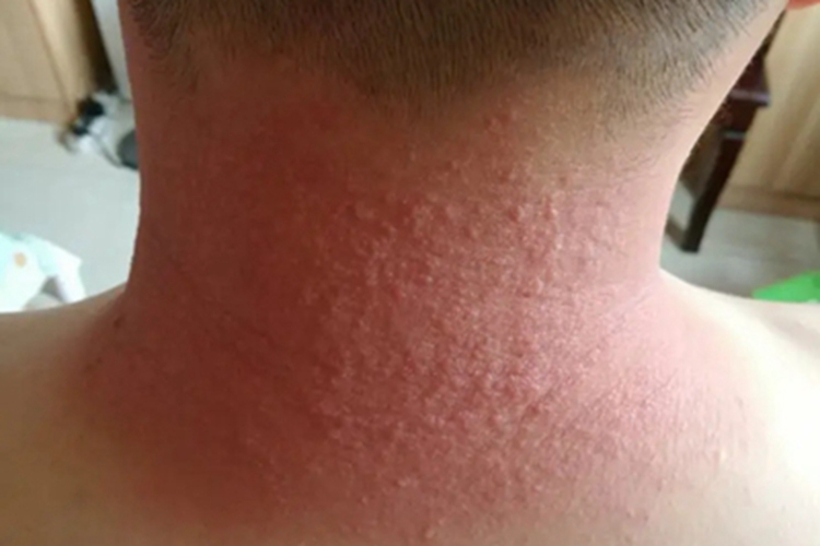 色素性痒疹脖子成片红疙瘩图 色素性痒疹脖子成片红疙瘩图