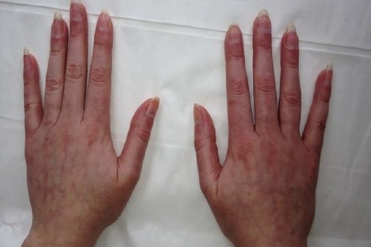 复发性多软骨炎手背症状图 复发性多软骨炎手背症状图