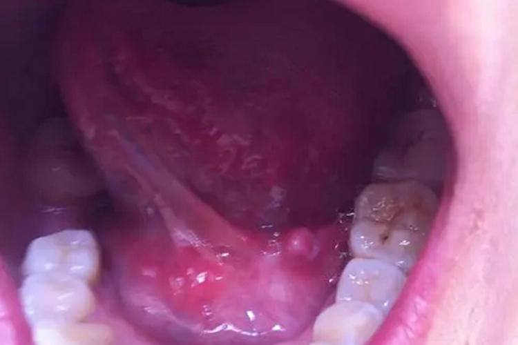 唾液腺黏液囊肿图