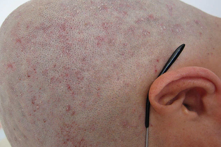 艾滋病头皮红疹图