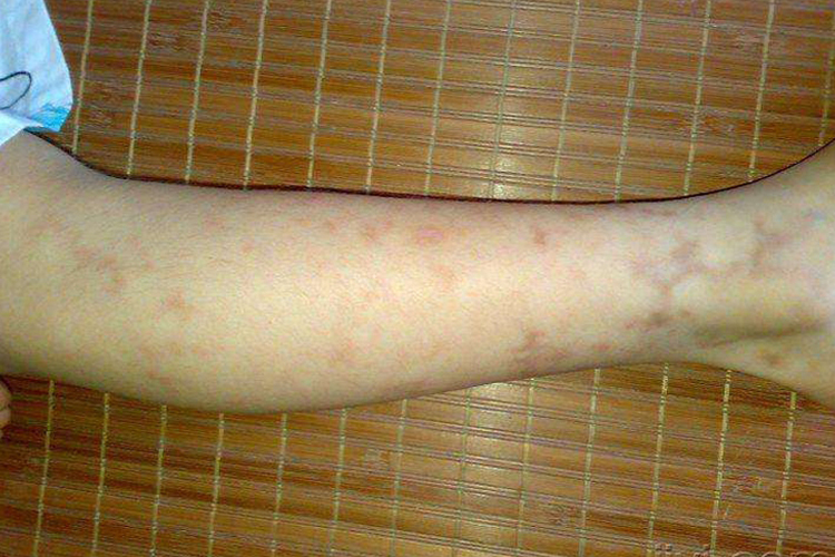 腿部毛细血管环状紫癜图