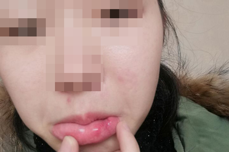 嘴唇囊肿术缝线脱落图