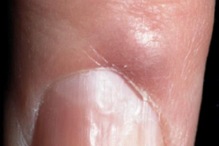 黏液样囊肿手指结节图