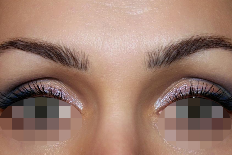 内高外低型双眼皮图