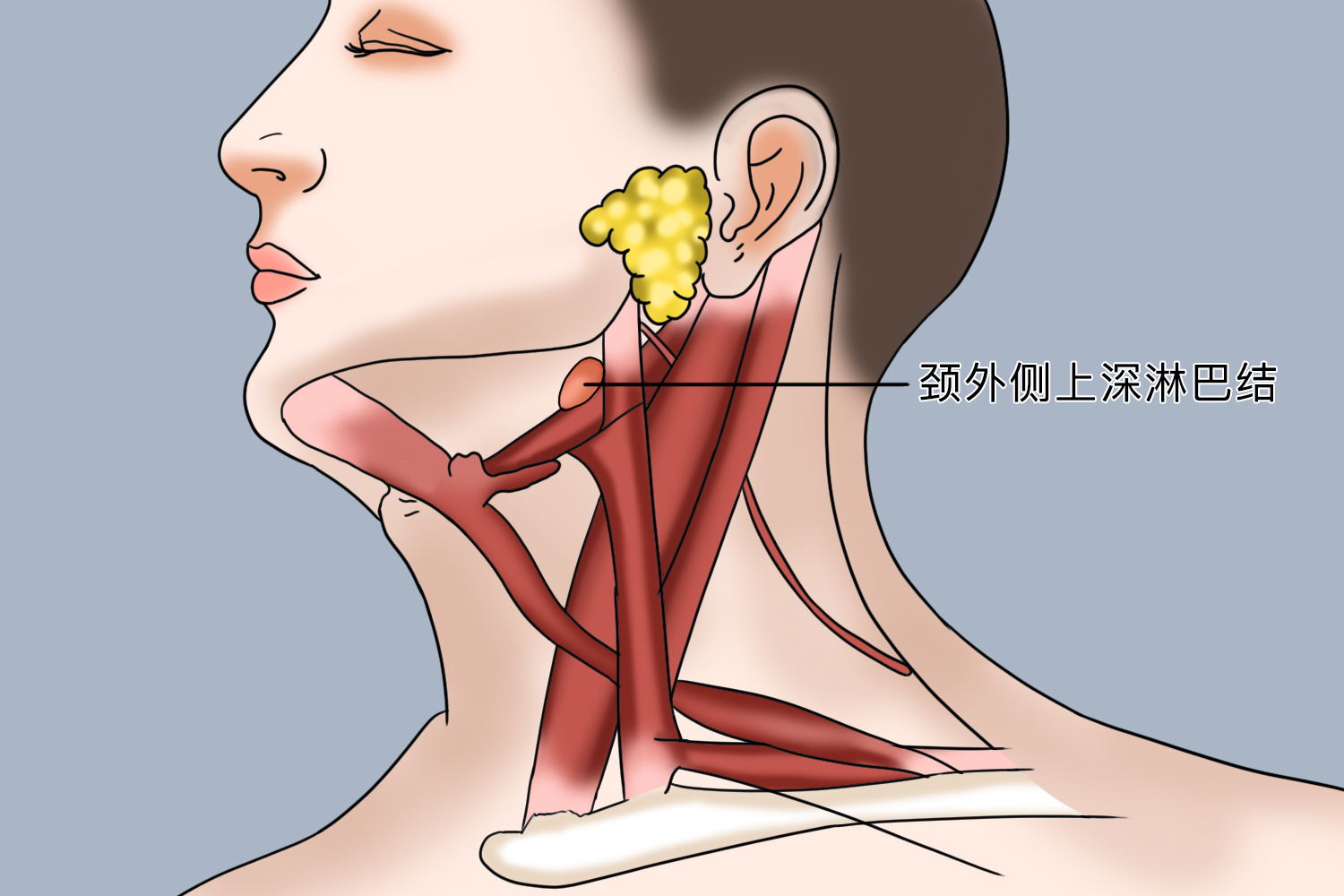 鼻咽癌肿块位置图