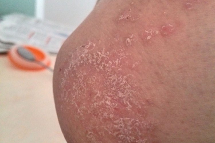 局限性神经性皮炎肘部丘疹图