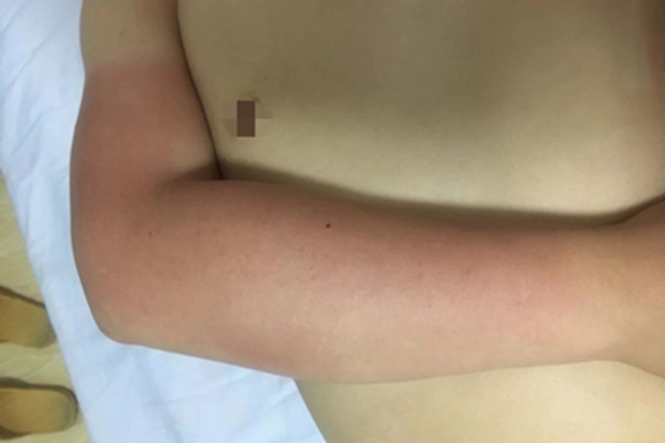 日晒伤胳膊晒红一大片图