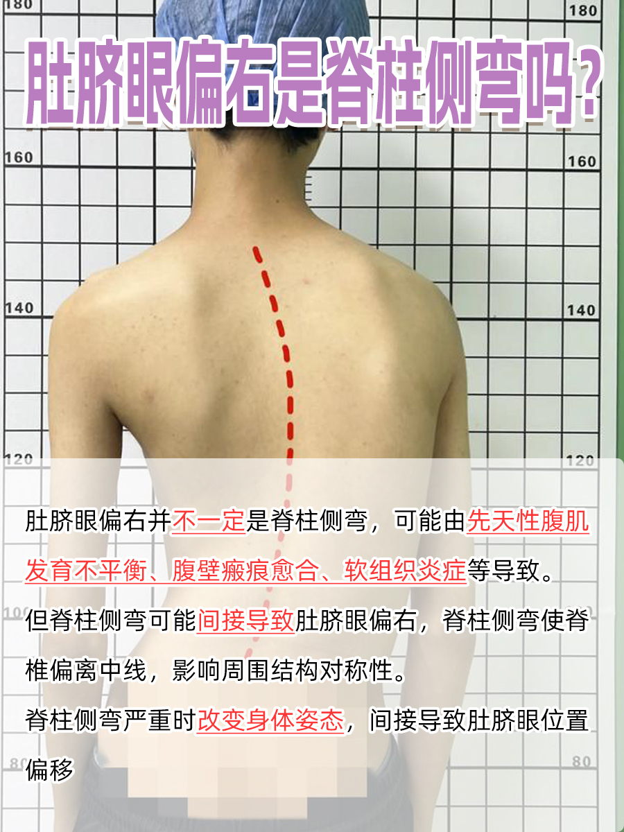 惊！肚脐眼偏右，脊柱侧弯预警？
