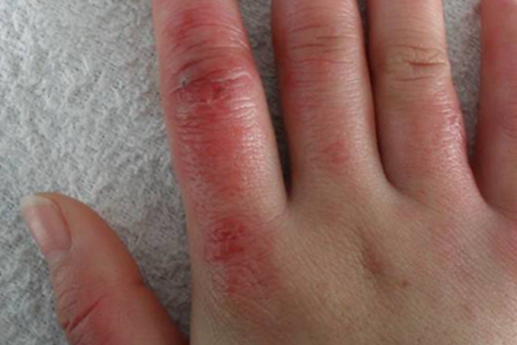 冻疮手指发红肿胀破溃图 冻疮手指发红肿胀破溃图