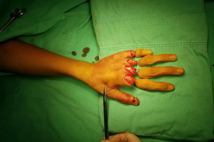 手指完全性断离图