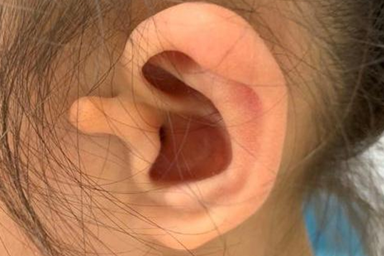 副耳畸形图