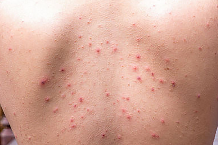 躯干处丘疹性荨麻疹图