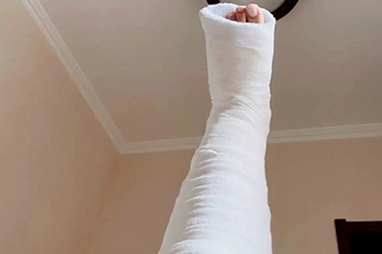 腿骨折石膏固定图