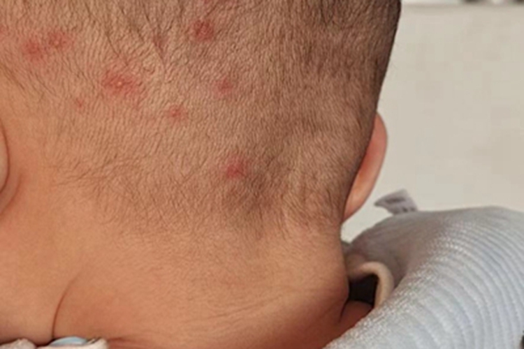 亚急性湿疹头皮症状图