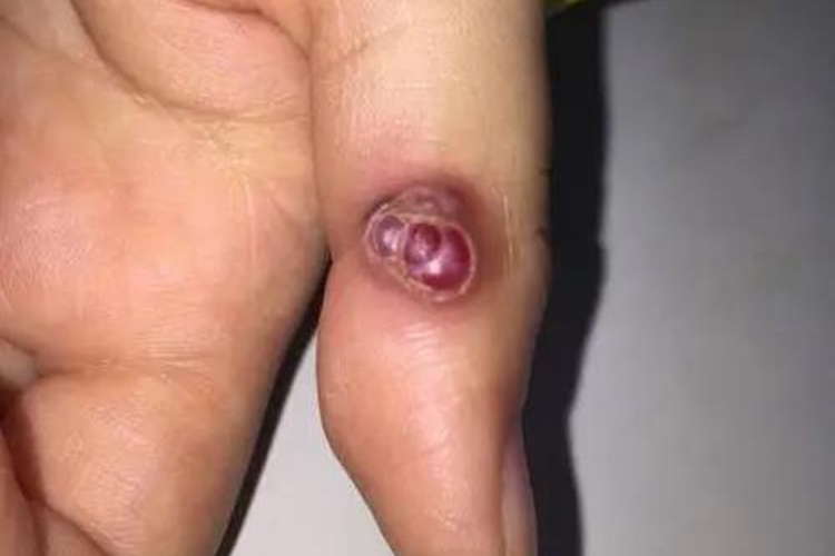 手指化脓性肉芽肿图
