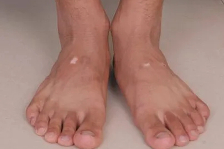 白癜风图 白癜风图