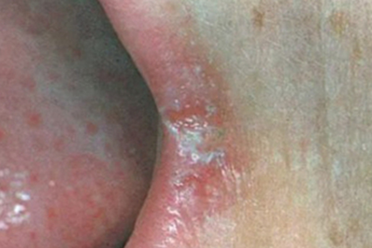 念珠菌性口角炎嘴唇糜烂图 念珠菌性口角炎嘴唇糜烂图