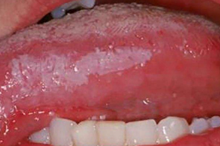 白色海绵痣舌侧有白斑图