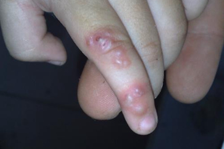 手部湿疹手指脓包图 手部湿疹手指脓包图