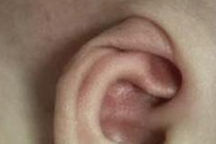 新生儿先天性外耳畸形(隐耳)图 新生儿先天性外耳畸形(隐耳)图