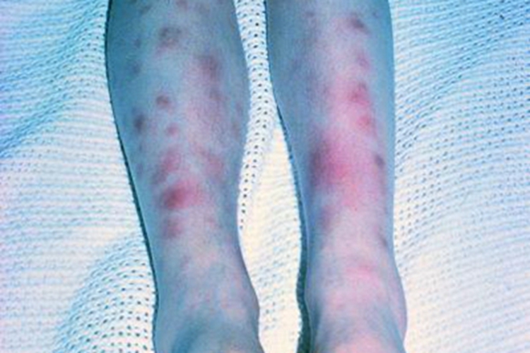 白塞病小腿上好多红斑图 白塞病小腿上好多红斑图