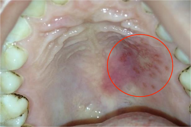 上颚部溃疡孔洞图 上颚部溃疡孔洞图
